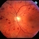 Ocular ischaemic syndrome colour 1 Ocular ischaemic syndrome colour 1