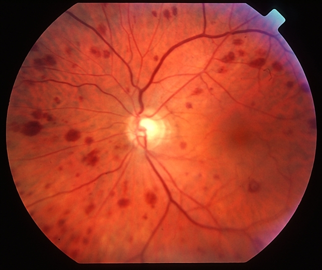 ocular ischemic syndrome diabetes management