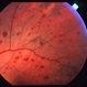 Ocular ischaemic syndrome colour 2 Ocular ischaemic syndrome colour 2