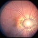 Morning glory optic disc Morning glory optic disc
