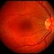 Canthaxanthine maculopathy RE