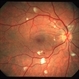 HIV retinopathy RE HIV retinopathy RE