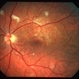 HIV retinopathy with resolving CMV retinitis - left eye HIV retinopathy with resolving CMV retinitis - left eye