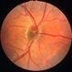 Optic nerve melanocytoma case 4 - image 1 Optic nerve melanocytoma case 4 - image 1