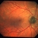 Optic nerve melanocytoma case 4 image 2 Optic nerve melanocytoma case 4 image 2