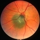 Optic nerve melanocytoma 1 image 1 Optic nerve melanocytoma 1 image 1