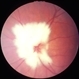 Myelinated nerve fibres at optic disc Myelinated nerve fibres at optic disc