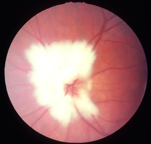 Myelinated Nerve Fibres At Optic Disc Retina Image Bank myelinated-nerve-fibres-at-optic-disc-retina-image-bank