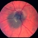 Optic nerve melanocytoma 1 image 2 Optic nerve melanocytoma 1 image 2