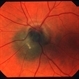 Optic nerve melanocytoma 1 image 3 Optic nerve melanocytoma 1 image 3