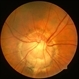 Optic disc dysplasia Optic disc dysplasia
