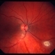 Astrocytic hamartoma of the retina Astrocytic hamartoma of the retina