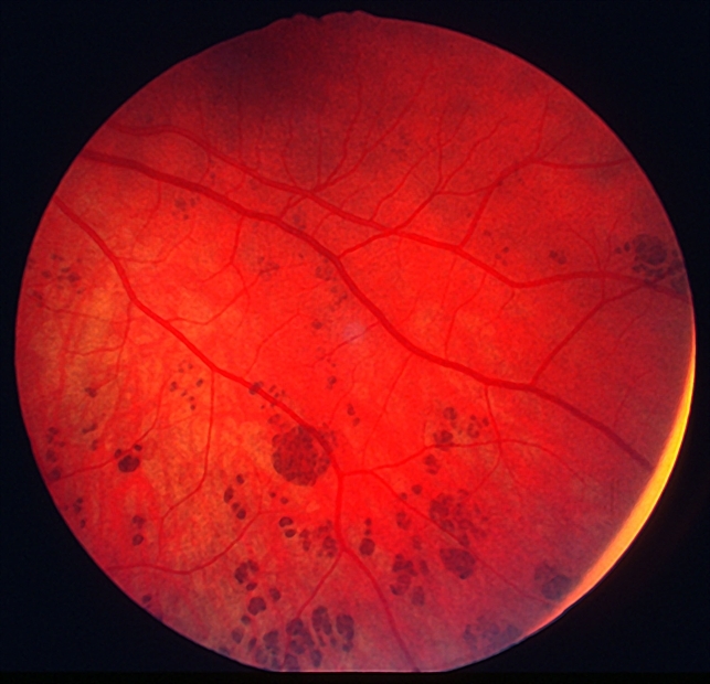 CHRPE - grouped pigmentation - Retina Image Bank