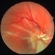 Tractional retinal detachment post IOFB Tractional retinal detachment post IOFB
