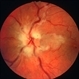 CRVO  with cilioretinal artery occlusion CRVO  with cilioretinal artery occlusion