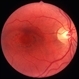 Chloroquine maculopathy 1 Chloroquine maculopathy 1