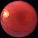 Chloroquine maculopathy 2 Chloroquine maculopathy 2
