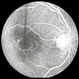 Chloroquine maculopathy 3 Chloroquine maculopathy 3