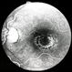 Chloroquine maculopathy 5 Chloroquine maculopathy 5