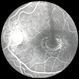 Chloroquine maculopathy 6 Chloroquine maculopathy 6