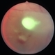 Candida endophthalmitis Candida endophthalmitis