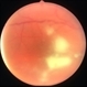 Candida endophthalmitis 2 Candida endophthalmitis 2