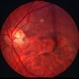 Optic disc pit - L stereo Optic disc pit - L stereo