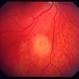 Small choroidal metastasis Small choroidal metastasis