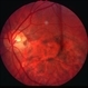Optic disc pit - R stereo Optic disc pit - R stereo