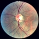 Optic disc pit 3 Optic disc pit 3
