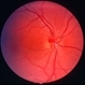 Congenital prepapillary vascular loop Congenital prepapillary vascular loop