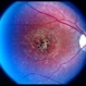Stargardt disease Stargardt disease
