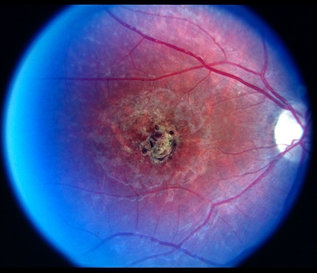 Stargardt disease Retina Image Bank