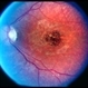 Stargardt disease Stargardt disease