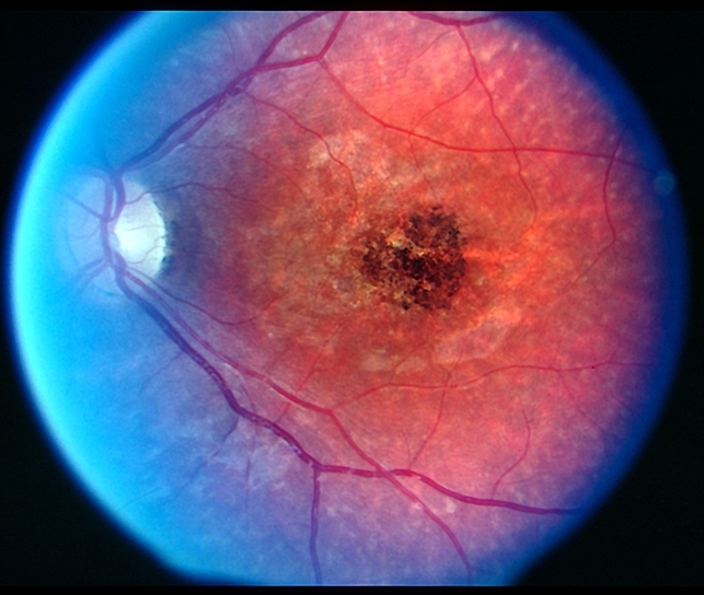 Stargardt disease Retina Image Bank