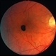 Congenital RPE hamartoma Congenital RPE hamartoma