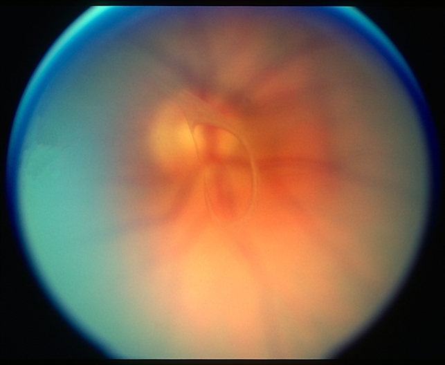 Posterior Vitreous Detachment Retina Image Bank