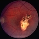 Toxoplasma chorioretinitis 1 Toxoplasma chorioretinitis 1