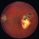 Toxoplasma chorioretinitis 2 Toxoplasma chorioretinitis 2