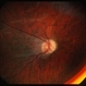 Retinopathy of prematurity - dragged disc Retinopathy of prematurity - dragged disc