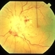 Hyperviscosity retinopathy