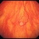Retinal capillary hemangioma 2 Retinal capillary hemangioma 2