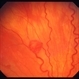 Retinal capillary hemangiomas 3 Retinal capillary hemangiomas 3