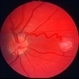Retinal capillary hemangioma Retinal capillary hemangioma