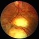 Chorioretinal coloboma 1 Chorioretinal coloboma 1