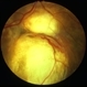 Chorioretinal coloboma 2 Chorioretinal coloboma 2