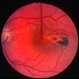 Torpedo maculopathy Torpedo maculopathy