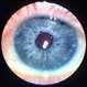 Iris clip IOL Iris clip IOL