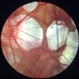 Myopic macular degeneration Myopic macular degeneration