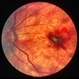 Myopic CNV Myopic CNV